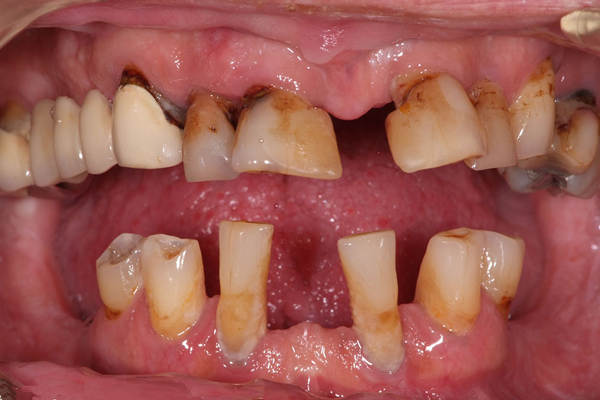 When having periodontitis should do dental implants or not?