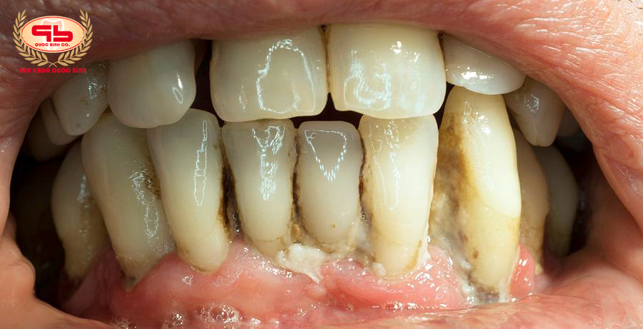 Vôi răng có vô hại như bạn nghĩ?