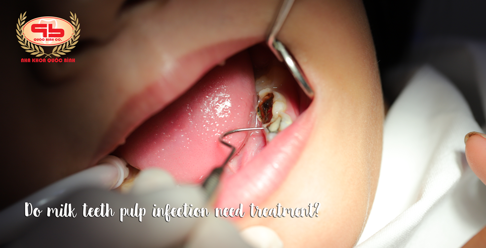 Do milk teeth pulp infection need treatment?