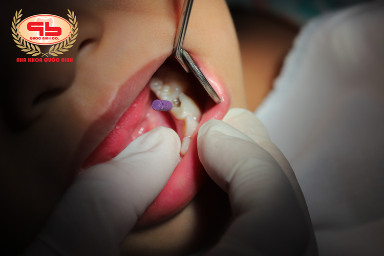 Treating a milk teeth pulp infection can reduce the risk of permanent tooth damage