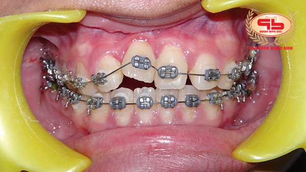 How long does the incisor braces take?