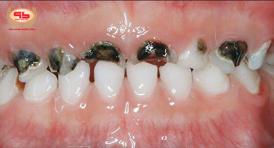 Bệnh răng miệng ở trẻ em thường gặp