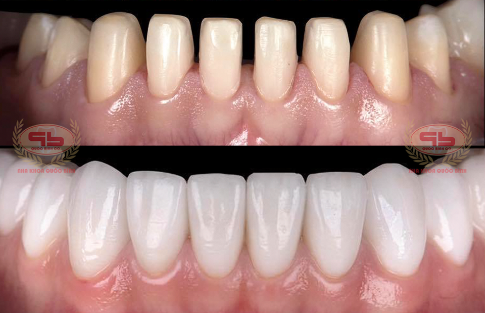 6 Notes when have porcelain crown aesthetics for Vung Tau customers.
