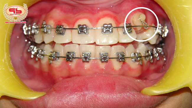 Shortage of permanent teeth but there are tooth germ that can pull out the right position