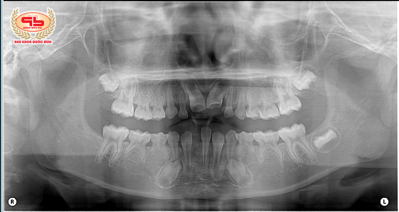 Shortage of permanent tooth due to no tooth germ