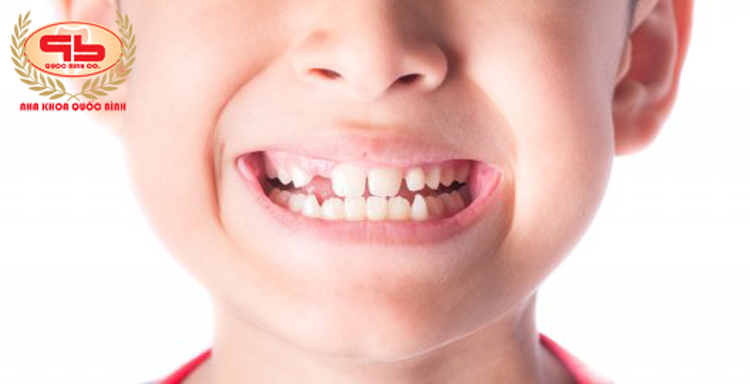 Thiếu răng vĩnh viễn và cách khắc phục