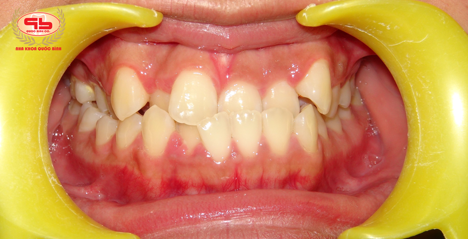 Khi bạn gặp phải tình trạng răng móm phải làm sao?