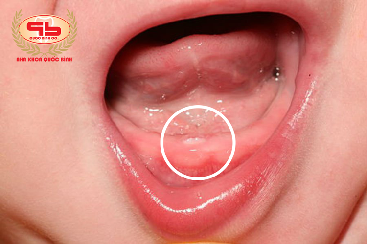 Bạn có biết bé mọc răng sữa trong bao lâu hay không?