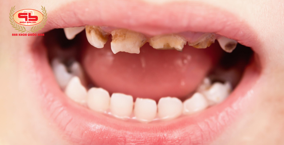 Trẻ bị sún răng sớm phải làm sao?