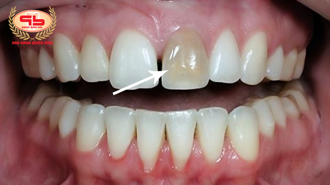 Broken incisors due to damaged dental pulp