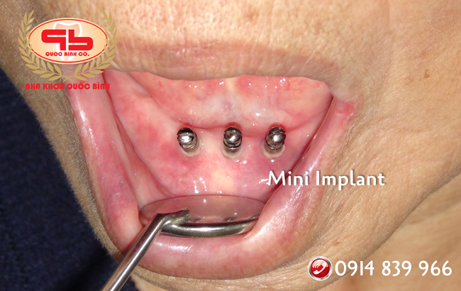 Removable denture on the Implant for the elderly.
