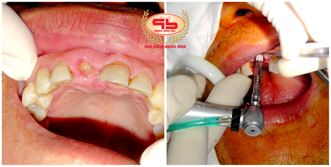 Instant dental implant for tooth loss due to an accident and root still remaining