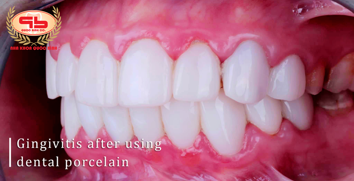 Some effective treatments for gingivitis after using dental porcelain