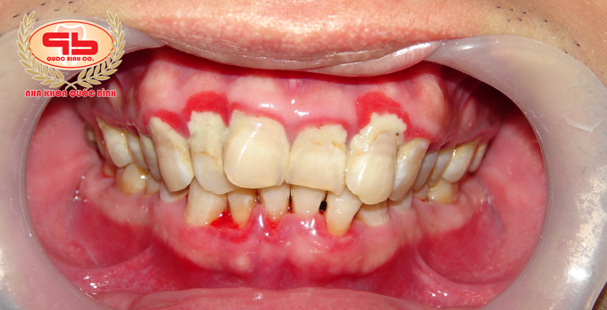 Loại bỏ vôi răng có gây ảnh hưởng xấu không, có nên thực hiện định kỳ?