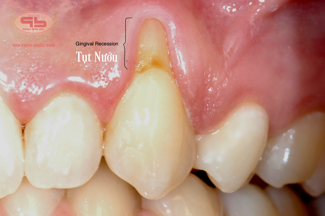 Receding gums need gum tissue graft treatment