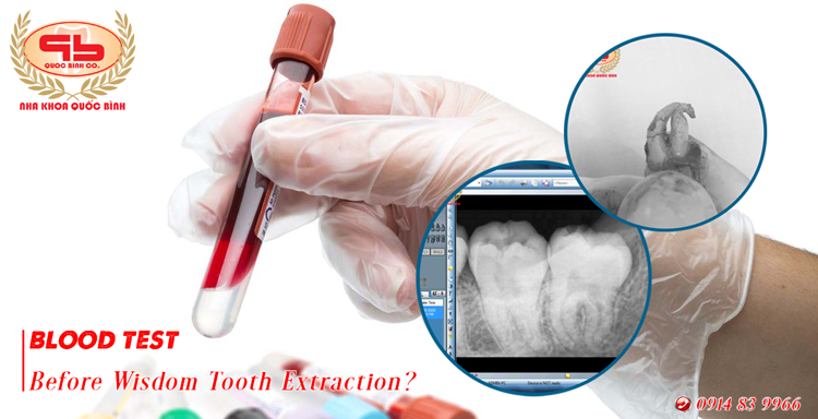 Is a blood test before wisdom tooth extraction necessary?