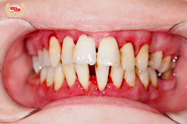 Đừng nhầm lẫn bệnh viêm nướu răng và viêm nha chu