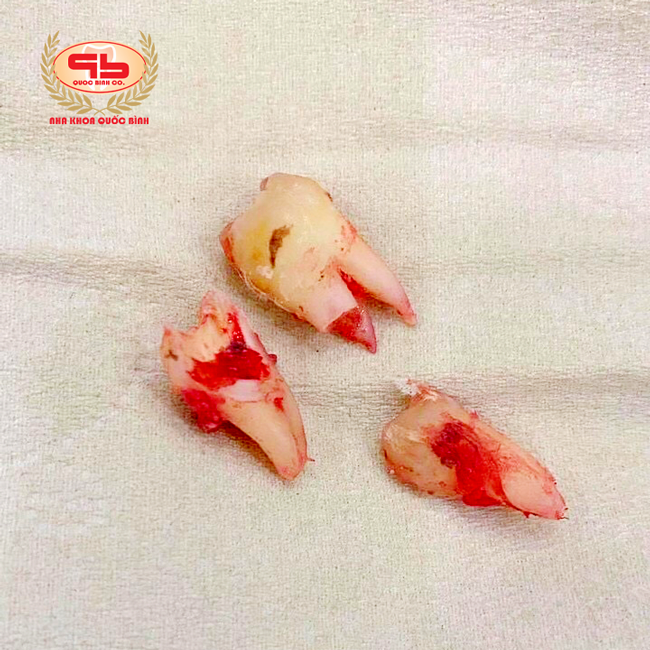 Horizontal wisdom tooth extraction with root division solution