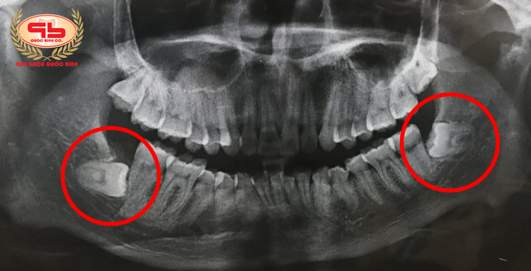 Răng khôn nằm ngang có tác hại gì?