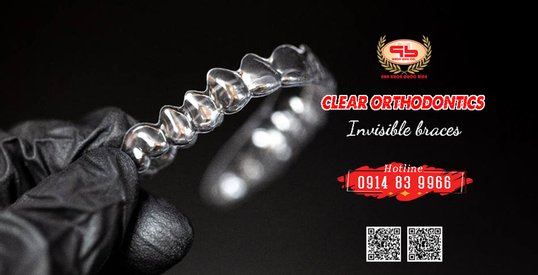 Clear braces bring aesthetics during the treatment