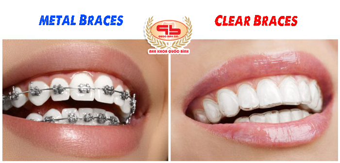 Clear braces bring aesthetics during the treatment
