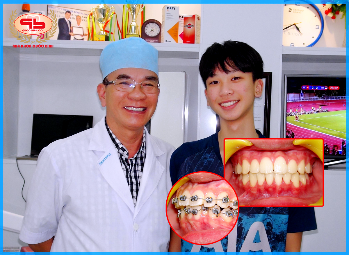 Kết thúc giai đoạn niềng răng, kết quả điều trị mỹ mãn
