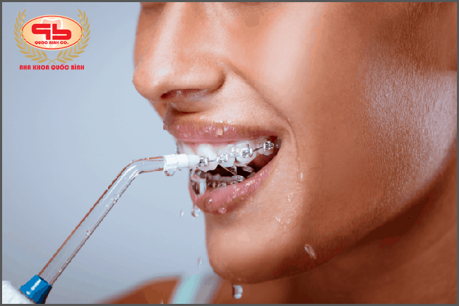 Máy tăm nước giúp vệ sinh răng sạch sẽ