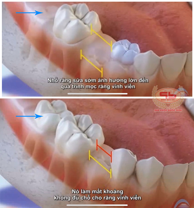 Nhổ răng sữa sớm gây mất khoảng không đủ chổ cho răng vĩnh viễn mọc lên