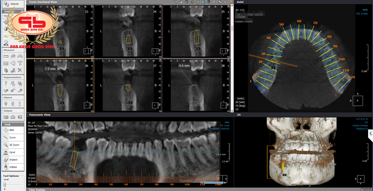 The role of CT cone beam in dentistry