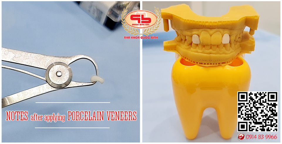 Remember the following notes after applying porcelain veneers