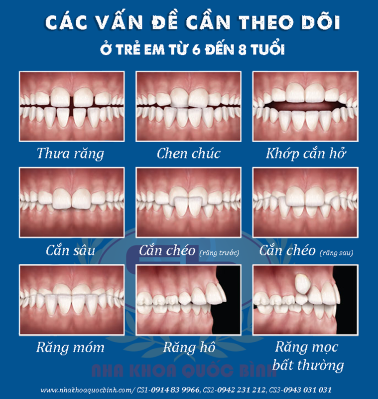 sai khớp cắn điển hình ở trẻ