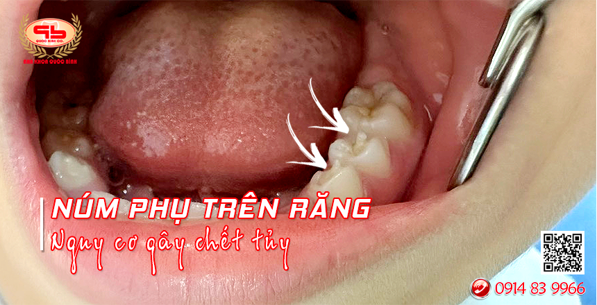 Núm phụ trên răng gây nguy cơ viêm tủy