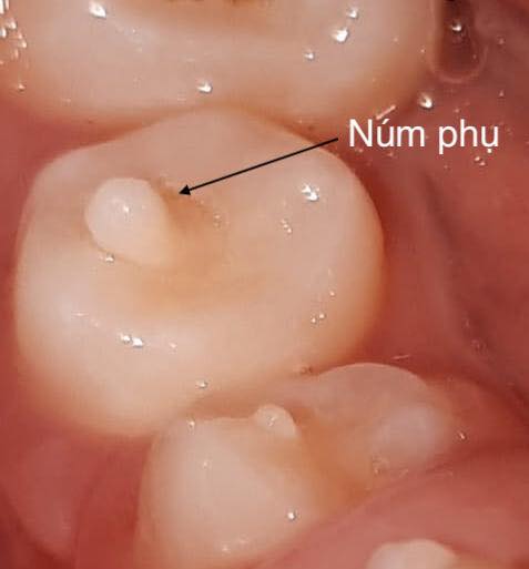 Núm phụ trên răng Núm phụ trên răng