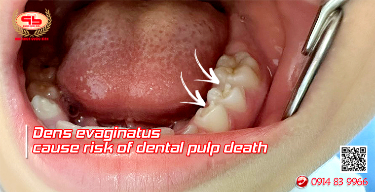 Dens evaginatus cause risk of dental pulp death
