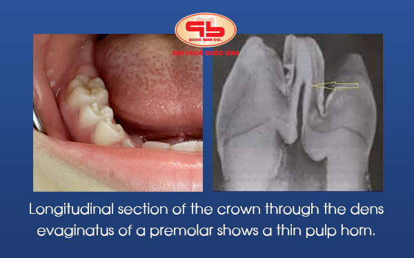 Longitudinal section of the crown through the dens evaginatus of a premolar shows a thin pulp horn. Longitudinal section of the crown through the dens evaginatus of a premolar shows a thin pulp horn.
