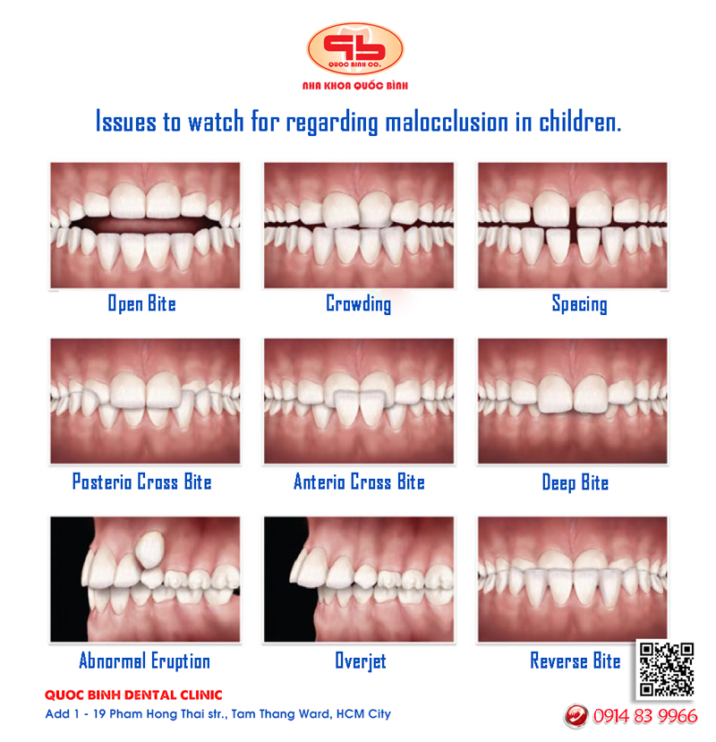 Types of occlusion: what they are, their causes and how to treat