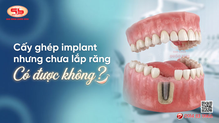 Trồng Implant nhưng chưa làm răng: