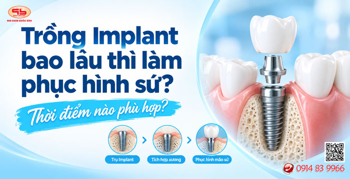 Trồng Implant bao lâu thì làm phục hình sứ?