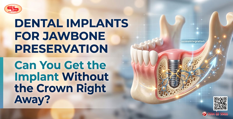 Dental Implants for Jawbone Preservation