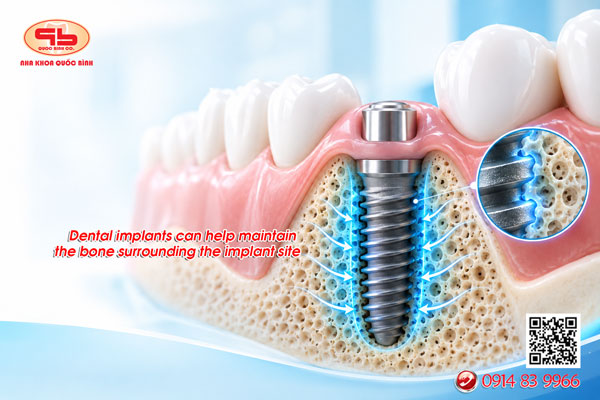 Dental implants can help maintain the bone surrounding the implant site