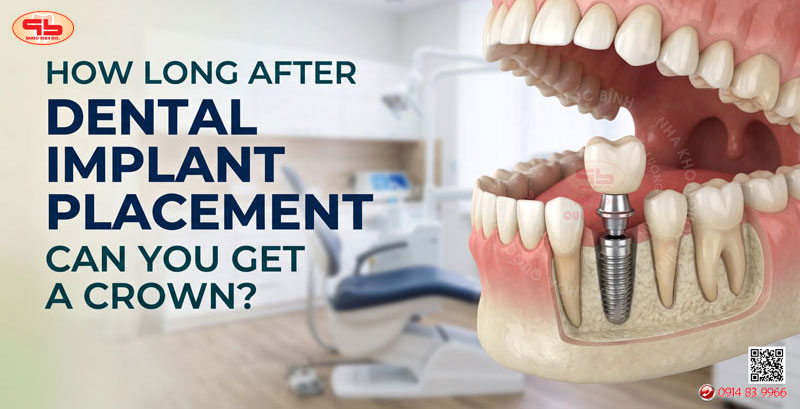How long after dental implant placement can you get a crown