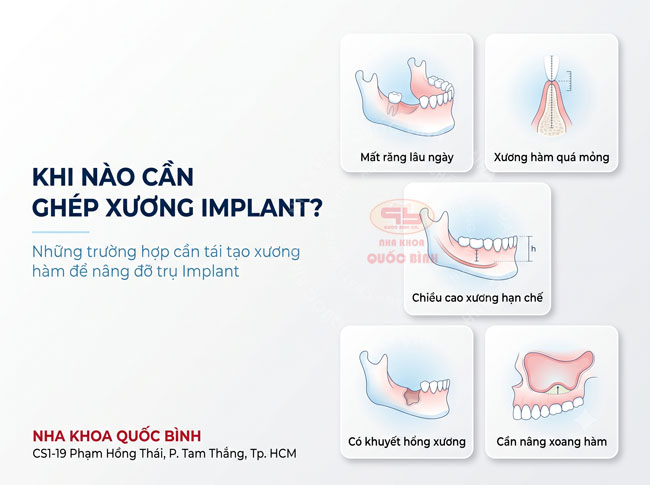 khi nào cần ghép xương Implant